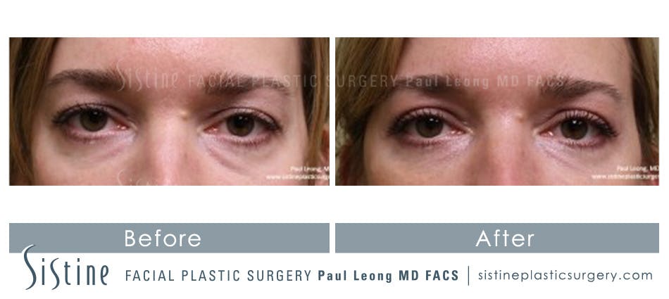 Eyes Before & After Gallery - Patient 4889811 - Image 1