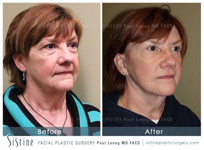 Eyes Before & After Gallery - Patient 4889813 - Image 2