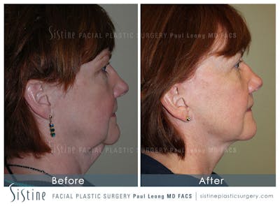 Eyes Before & After Gallery - Patient 4889813 - Image 4