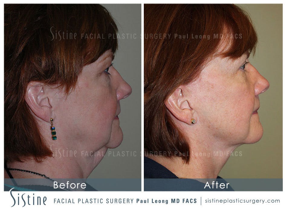 Eyes Before & After Gallery - Patient 4889813 - Image 4