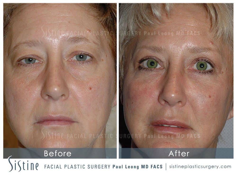 Eyes Before & After Gallery - Patient 4889815 - Image 1