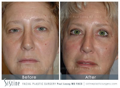 Eyes Before & After Gallery - Patient 4889815 - Image 1