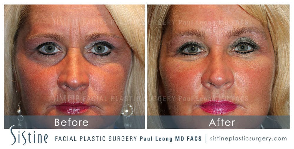 Eyes Before & After Gallery - Patient 4889817 - Image 1