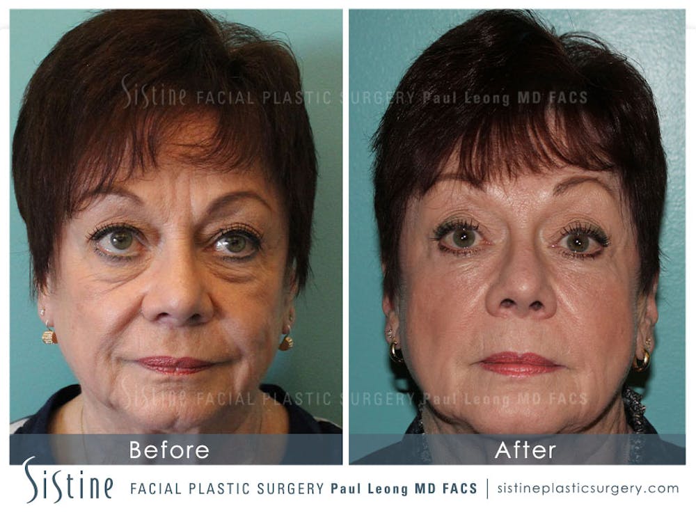 Eyes Before & After Gallery - Patient 4889824 - Image 1