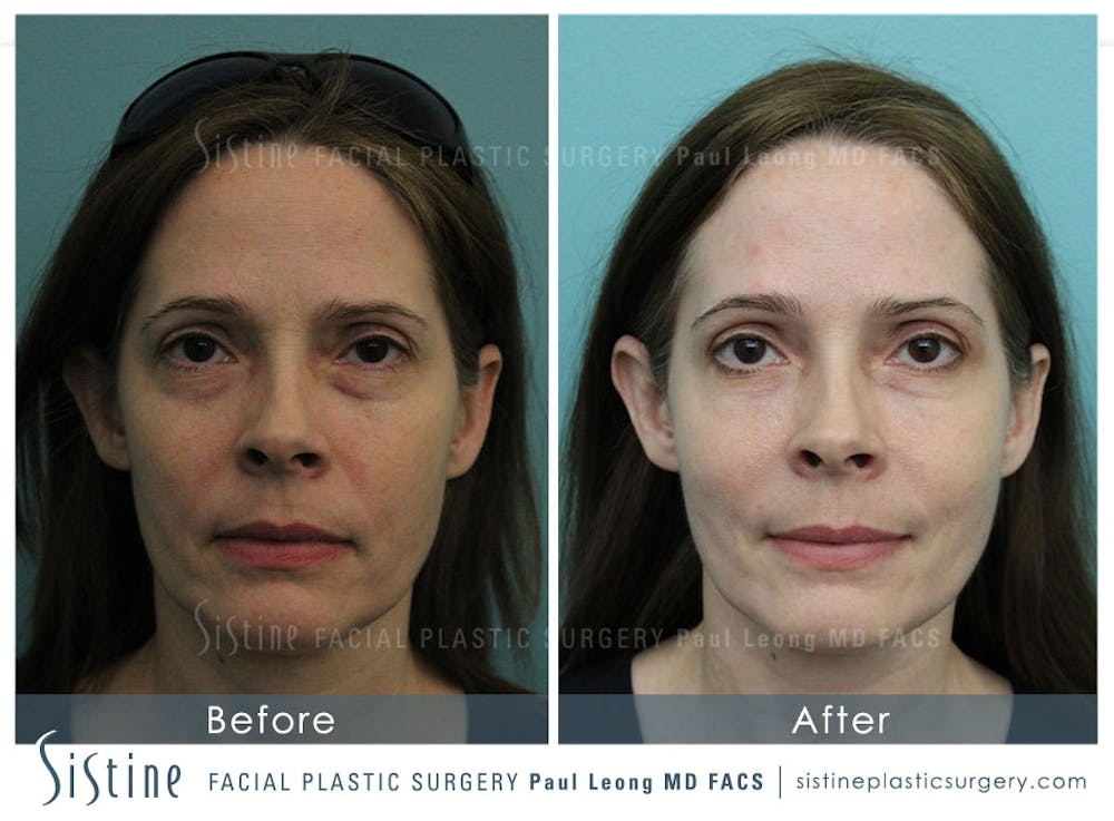 Eyes Before & After Gallery - Patient 4889828 - Image 1