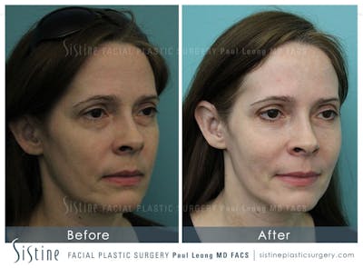 Eyes Before & After Gallery - Patient 4889828 - Image 2