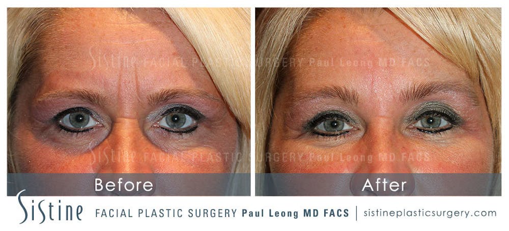 Eyes Before & After Gallery - Patient 4889829 - Image 1