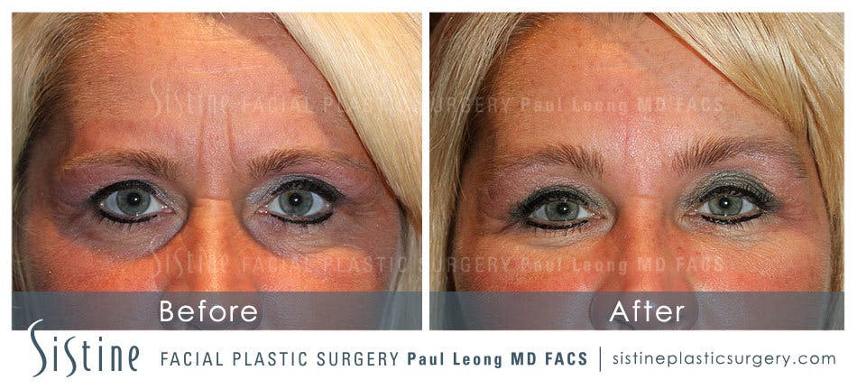 Eyes Before & After Gallery - Patient 4889829 - Image 1