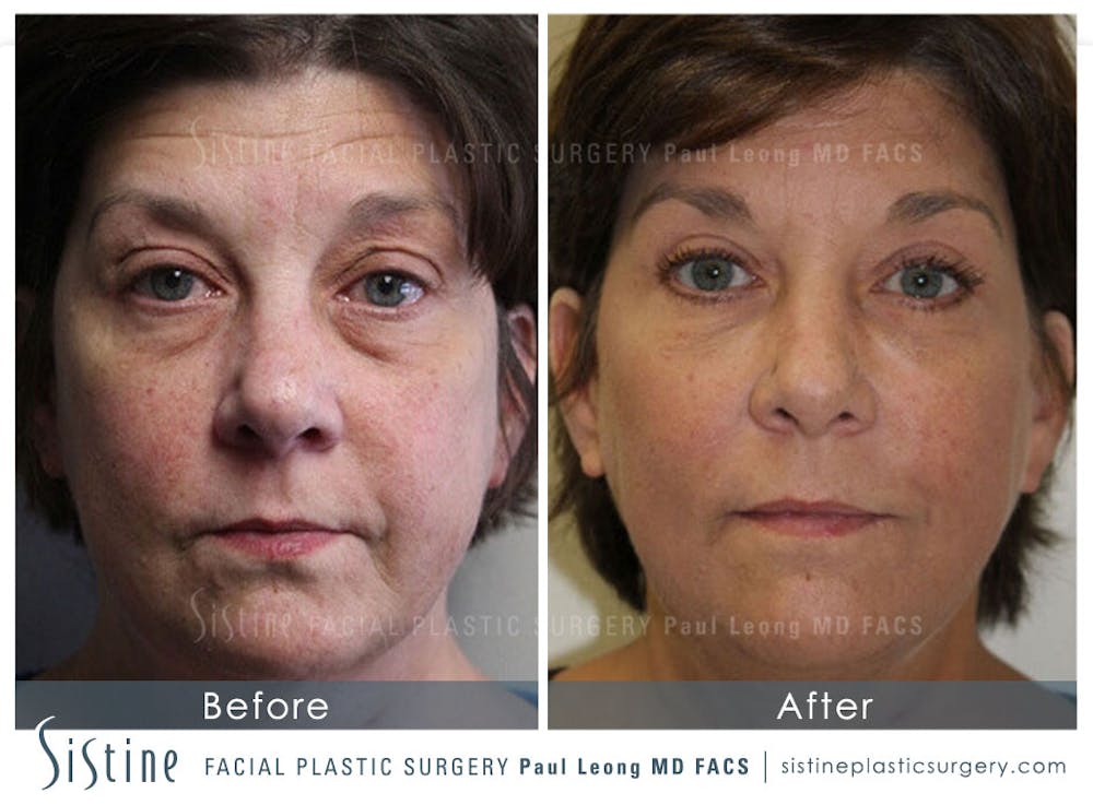 Eyes Before & After Gallery - Patient 4889830 - Image 1