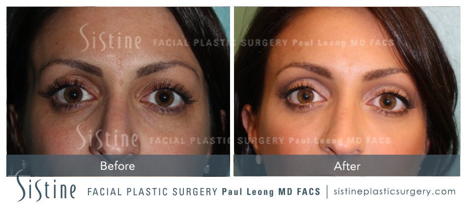 Eyes Before & After Gallery - Patient 4889834 - Image 1