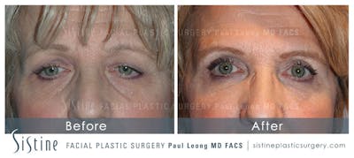 Eyes Before & After Gallery - Patient 4889847 - Image 1