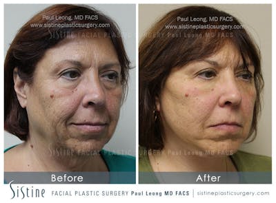Eyes Before & After Gallery - Patient 4889903 - Image 2