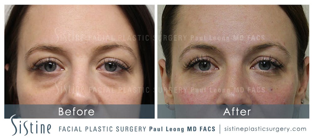 Eyes Before & After Gallery - Patient 4889904 - Image 1