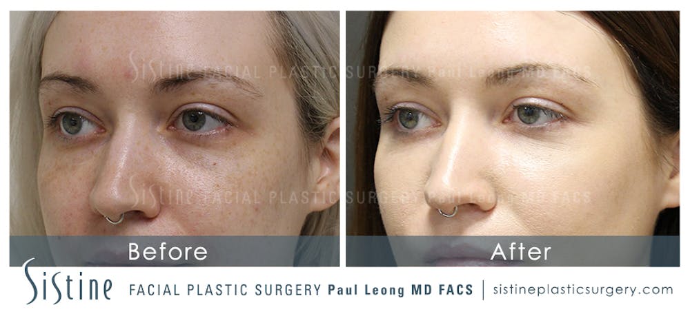 Eyes Before & After Gallery - Patient 4889907 - Image 1