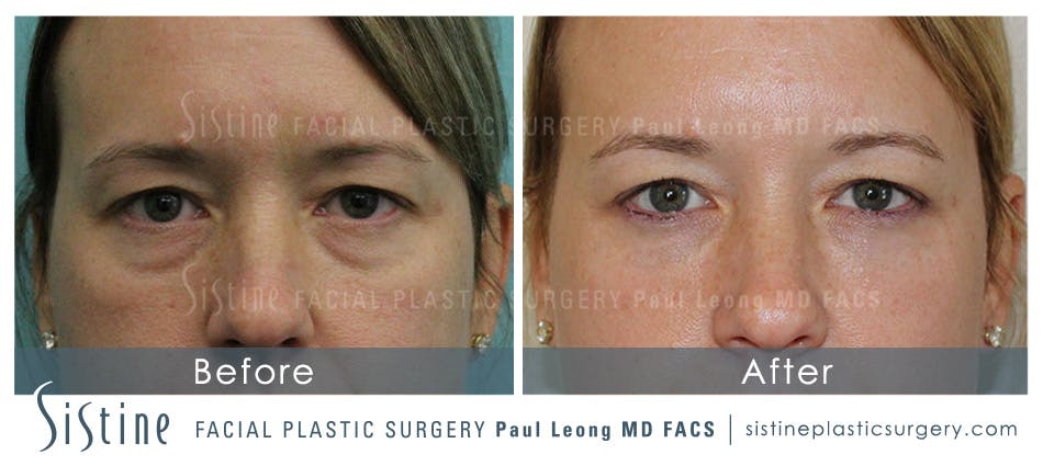 Eyes Before & After Gallery - Patient 4889910 - Image 2