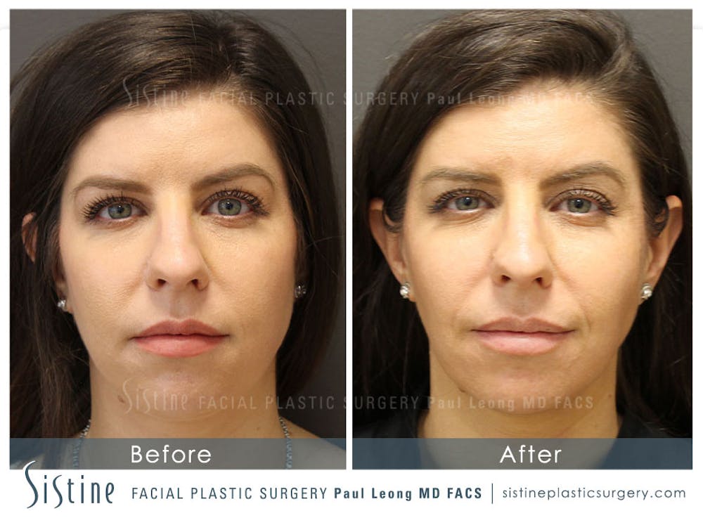 Masseter Before & After Gallery - Patient 4889942 - Image 1