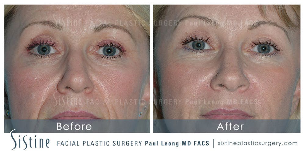 Nasolabial Folds Before & After Gallery - Patient 4889945 - Image 1