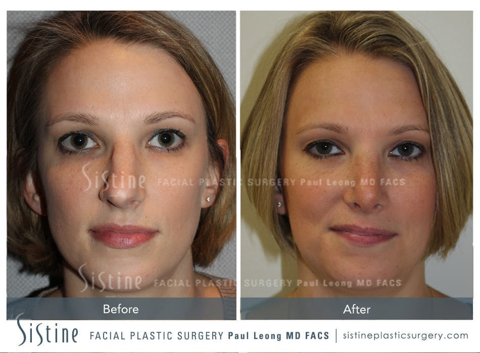 Nose Before & After Gallery - Patient 4889949 - Image 1