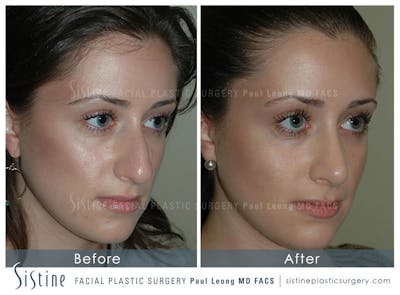 Nose Before & After Gallery - Patient 4889950 - Image 2