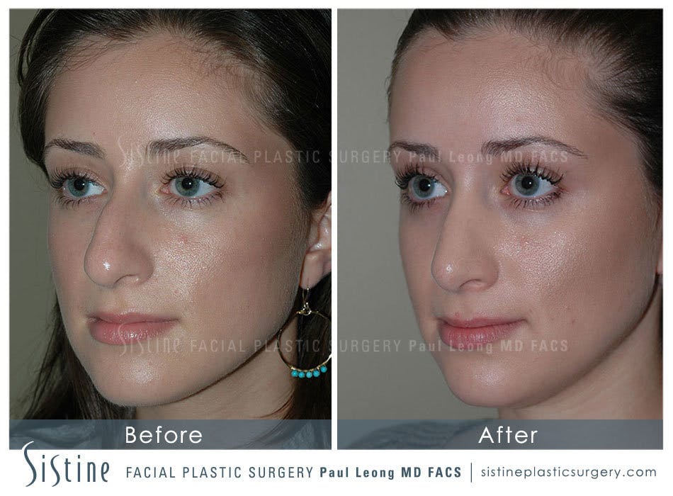 Nose Before & After Gallery - Patient 4889950 - Image 4