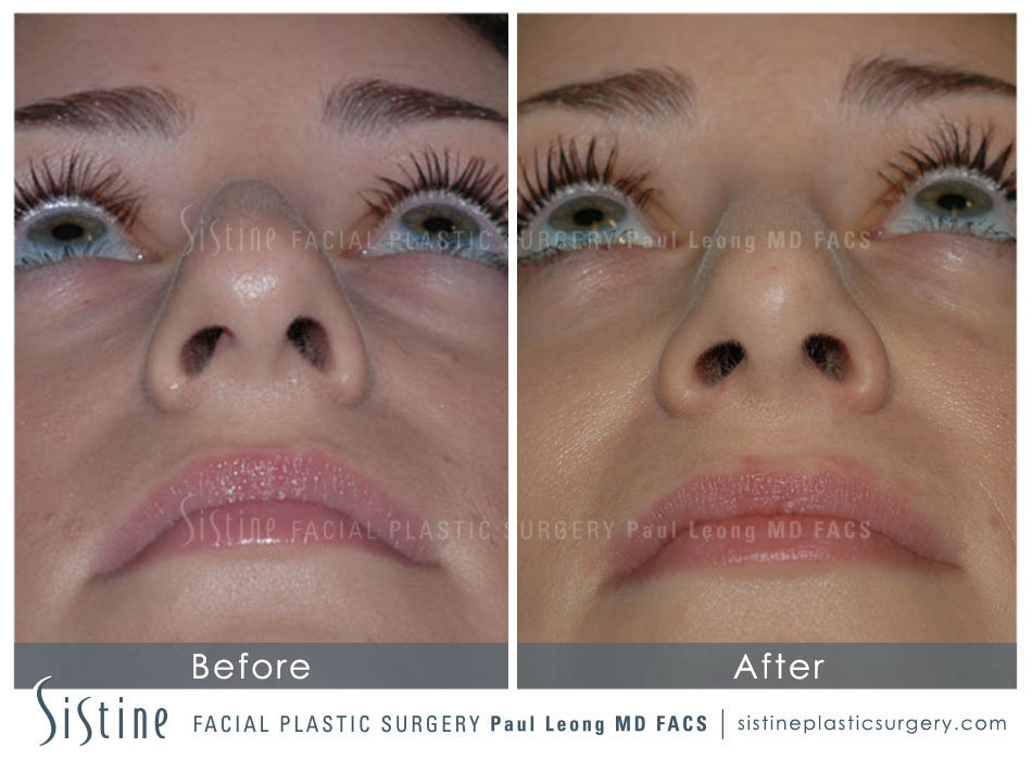 Patient 4889950 | Nose Gallery | Leong Aesthetics