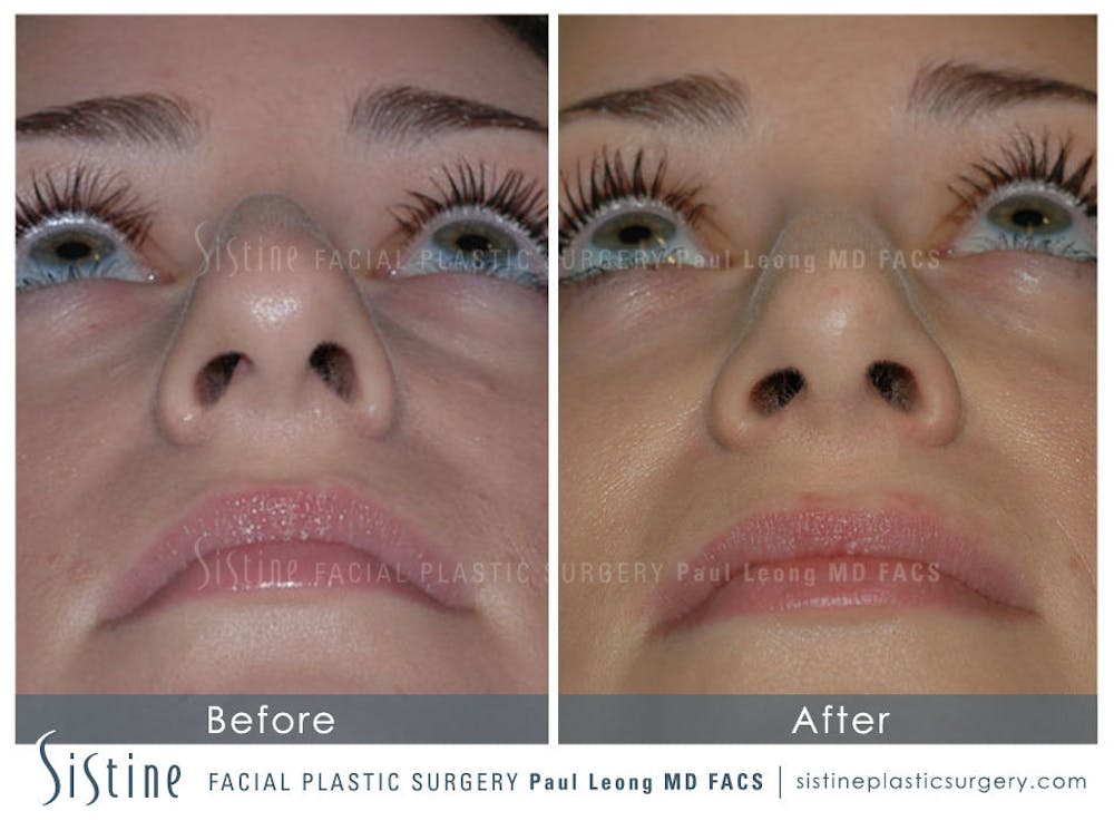 Nose Before & After Gallery - Patient 4889950 - Image 6
