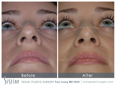 Nose Before & After Gallery - Patient 4889950 - Image 6
