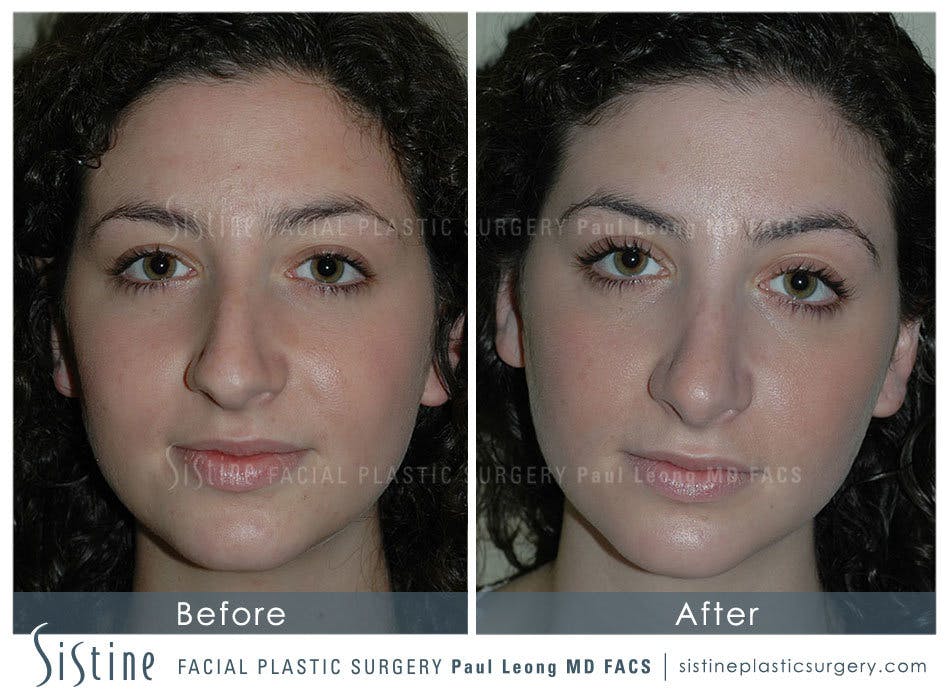 Nose Before & After Gallery - Patient 4889967 - Image 1