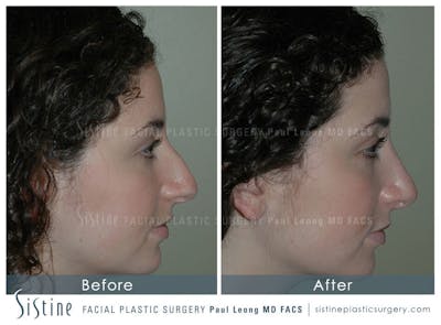 Nose Before & After Gallery - Patient 4889967 - Image 2