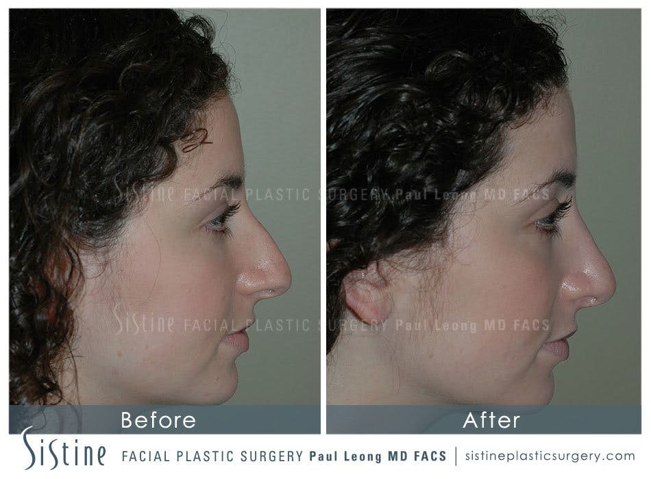 Nose Before & After Gallery - Patient 4889967 - Image 2