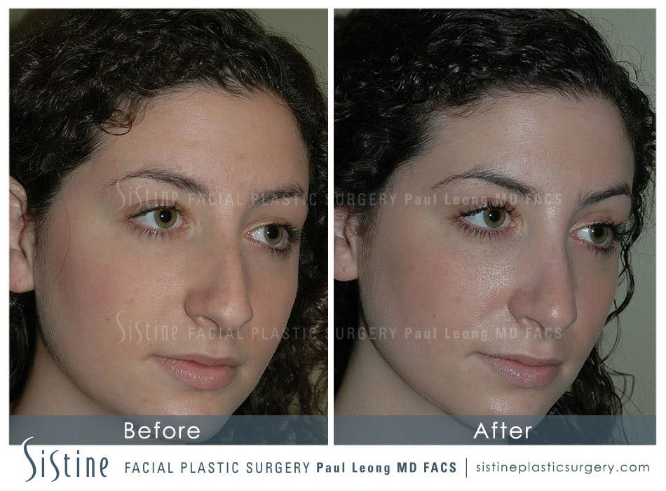 Nose Before & After Gallery - Patient 4889967 - Image 3