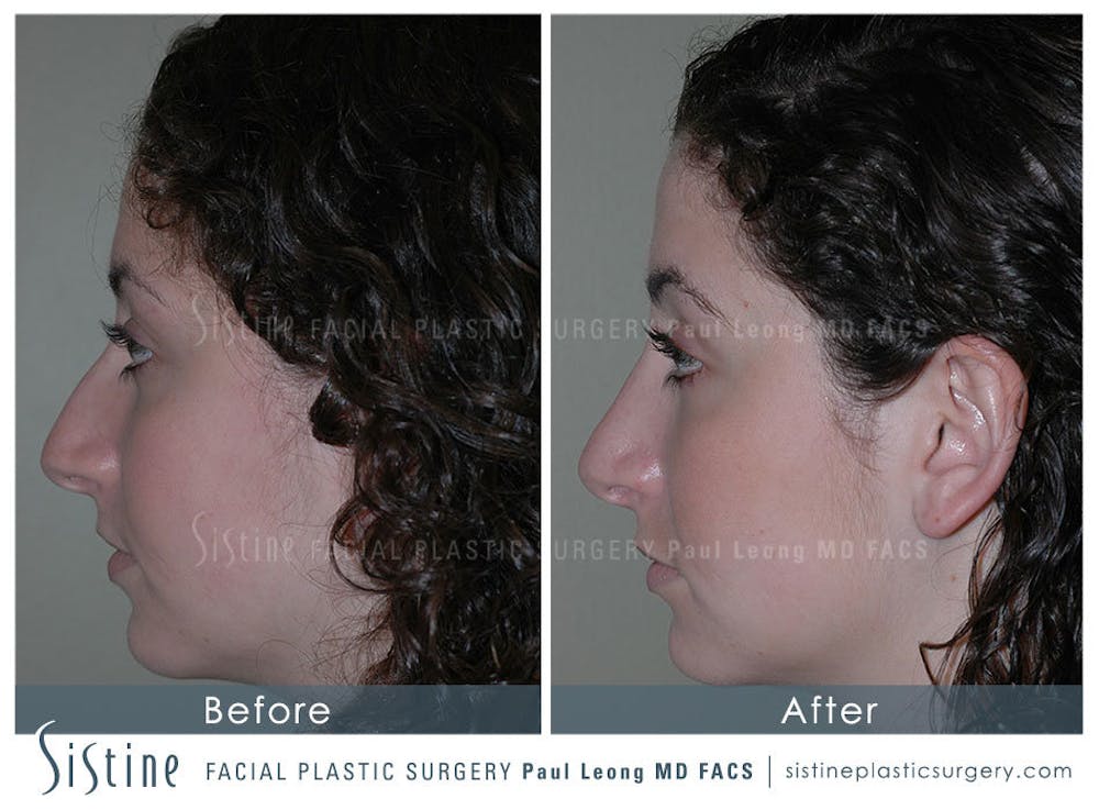 Nose Before & After Gallery - Patient 4889967 - Image 4