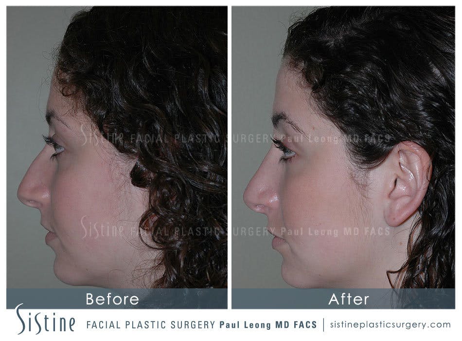 Nose Before & After Gallery - Patient 4889967 - Image 4