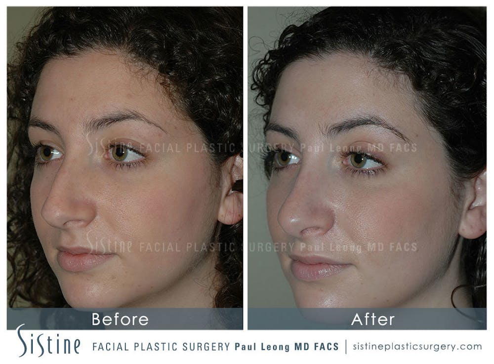 Nose Before & After Gallery - Patient 4889967 - Image 5