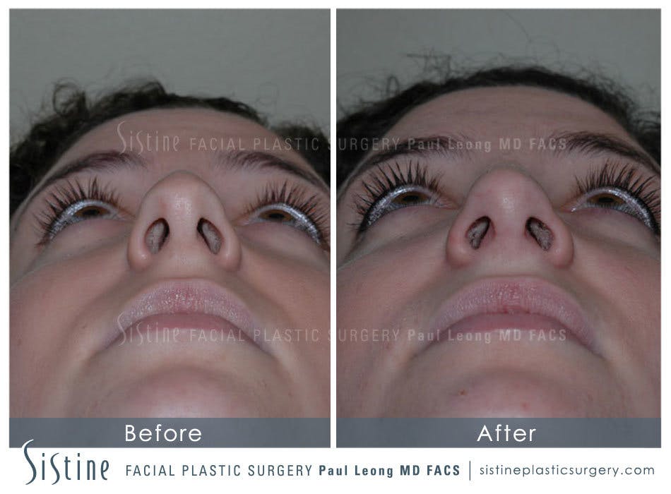 Nose Before & After Gallery - Patient 4889967 - Image 6