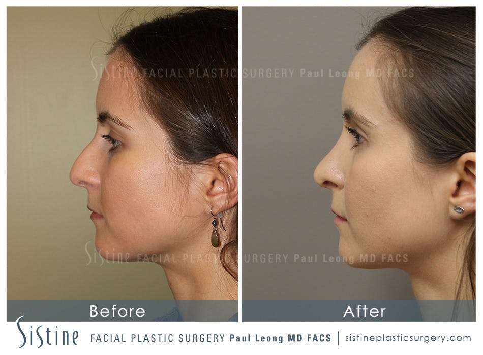 Nose Before & After Gallery - Patient 4889969 - Image 1