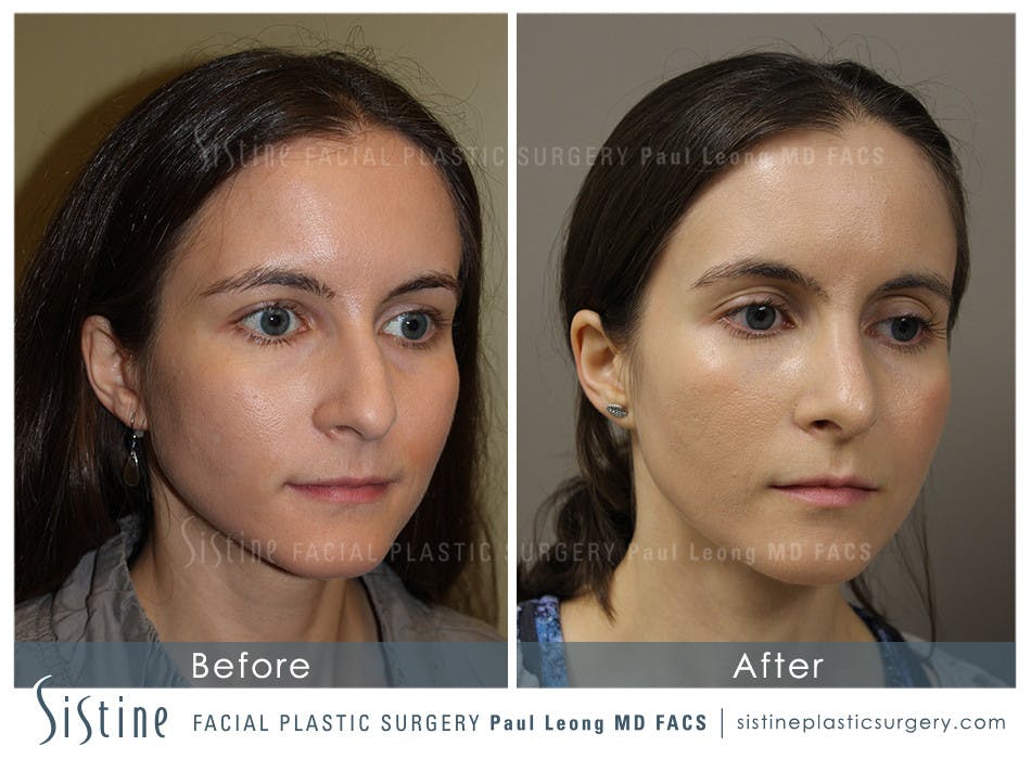 Nose Before & After Gallery - Patient 4889969 - Image 2