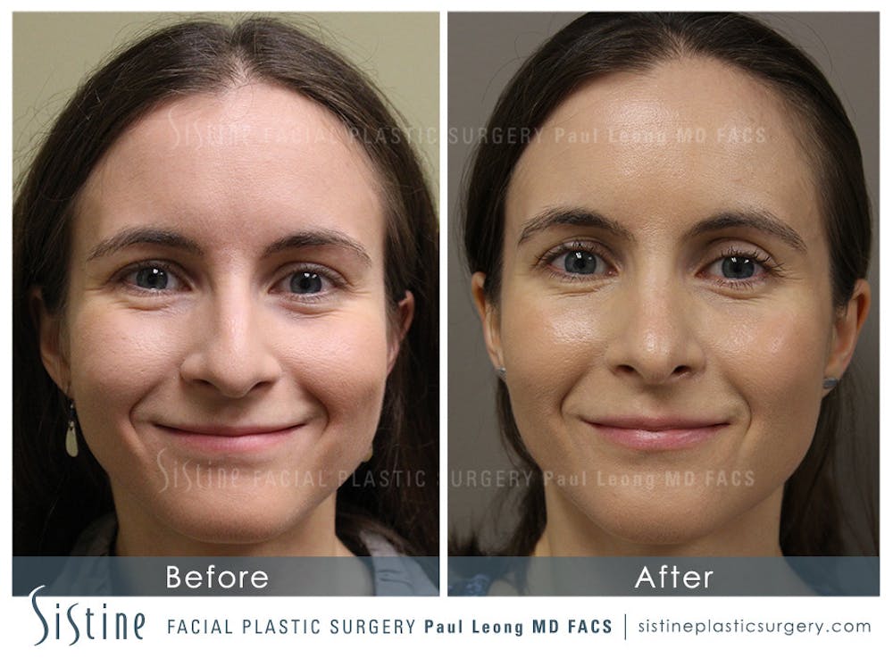 Nose Before & After Gallery - Patient 4889969 - Image 5