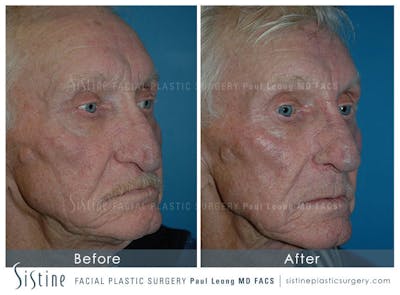 Nose Before & After Gallery - Patient 4889974 - Image 1