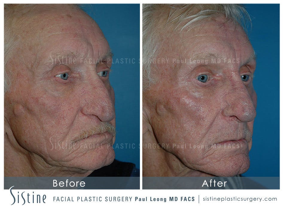 Nose Before & After Gallery - Patient 4889974 - Image 1