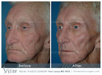 Nose Before & After Gallery - Patient 4889974 - Image 2