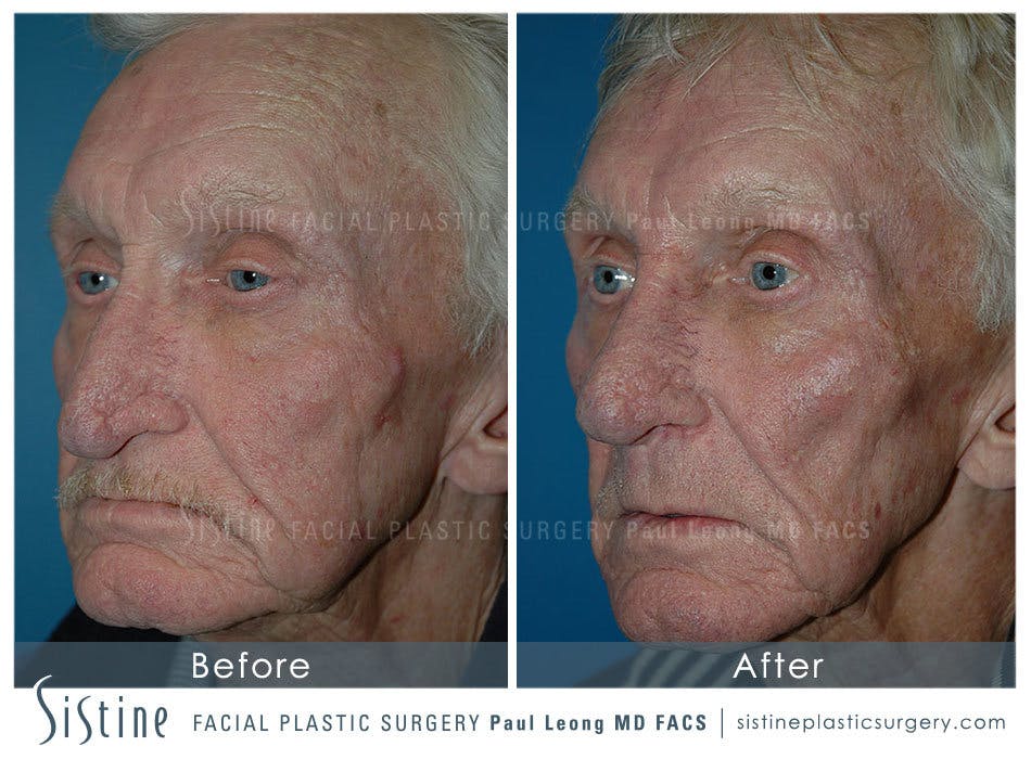 Nose Before & After Gallery - Patient 4889974 - Image 2