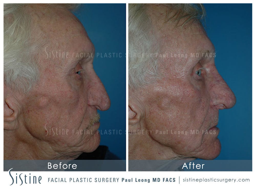 Nose Before & After Gallery - Patient 4889974 - Image 3