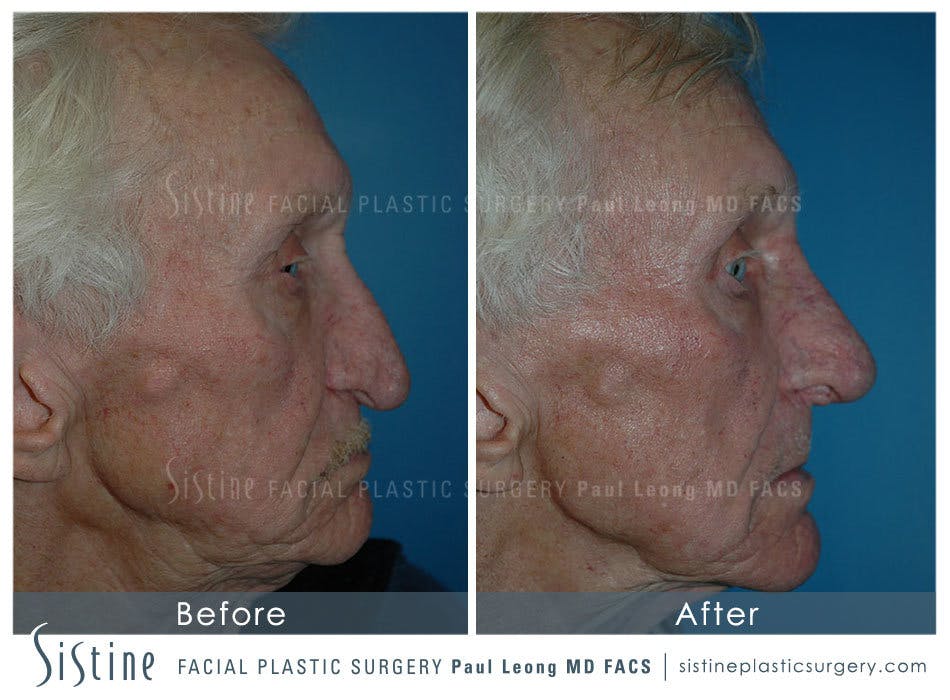 Nose Before & After Gallery - Patient 4889974 - Image 3
