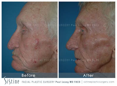 Nose Before & After Gallery - Patient 4889974 - Image 4
