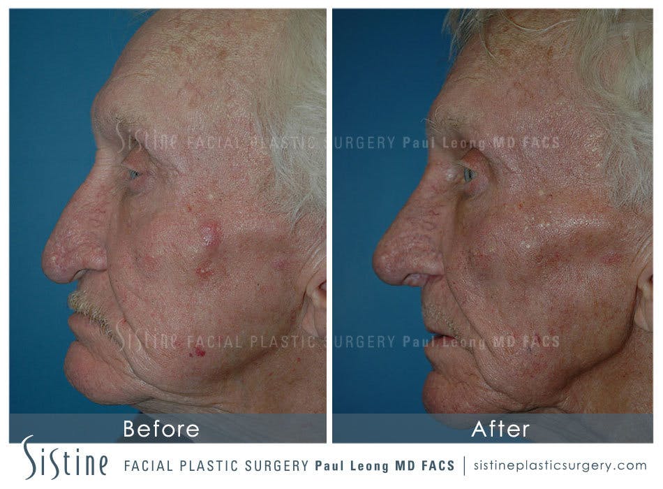 Nose Before & After Gallery - Patient 4889974 - Image 4