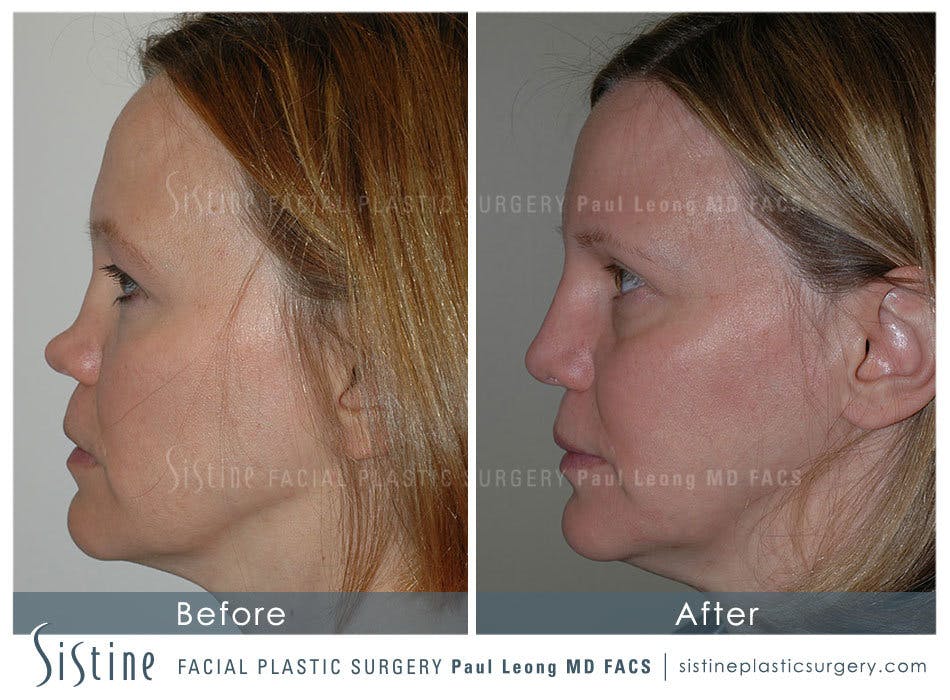 Nose Before & After Gallery - Patient 4890013 - Image 1
