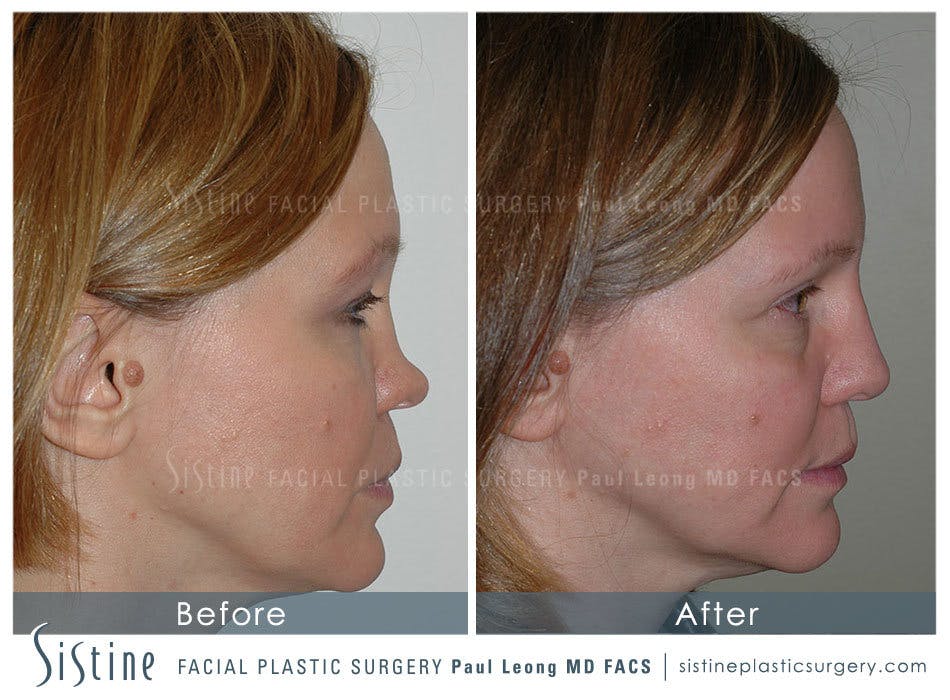 Nose Before & After Gallery - Patient 4890013 - Image 2