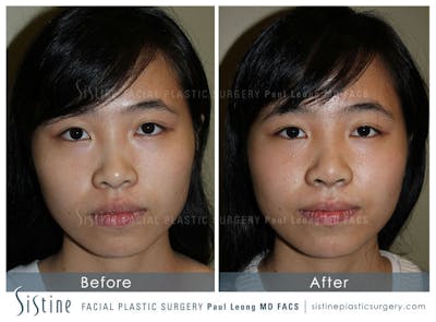 Nose Before & After Gallery - Patient 4890073 - Image 1