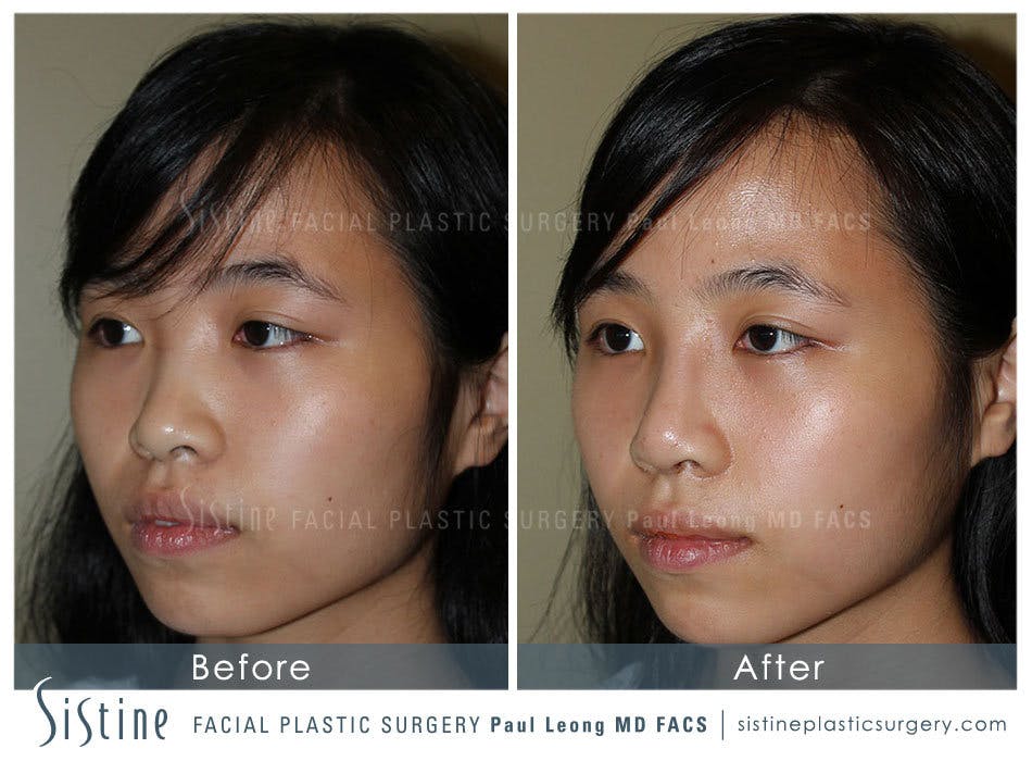Nose Before & After Gallery - Patient 4890073 - Image 3